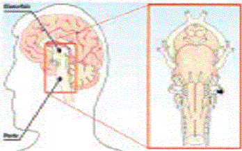 Discinesie - parkinsonitalia.it