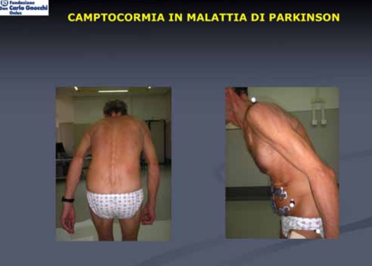 Parkinsonismi atipici